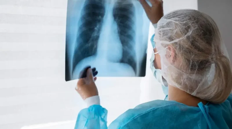 Más de 5.800 casos de cáncer de pulmón previstos en Venezuela para 2024