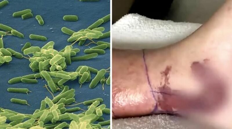 EE. UU. emite alerta por aumento de casos de bacteria “comecarne”